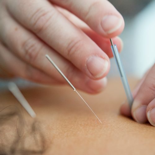 5 Schmerzfrei und effektiv – Akupunktur durch Laser-Frequenz-Modulation